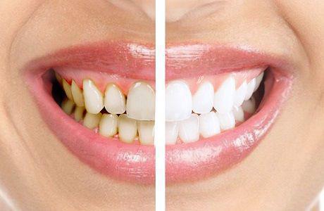 Зубний порошок: за та проти