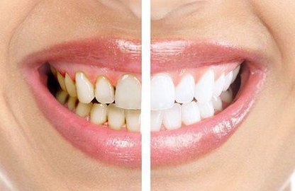 Зубний порошок: за та проти