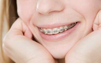 Догляд за брекет-системою за допомогою іригатора